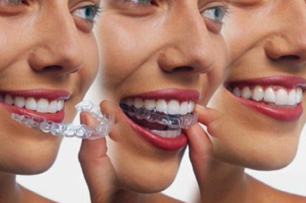 average cost of invisalign