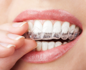 average cost of invisalign