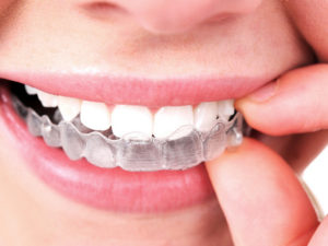 How Long Does It Take Invisalign to Work