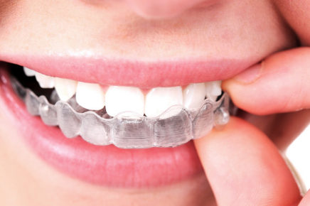 How Long Does It Take Invisalign to Work