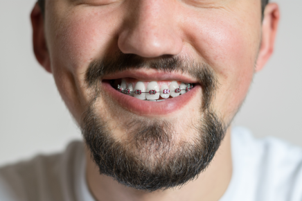 Braces for Adults: When are you too old for treatment?