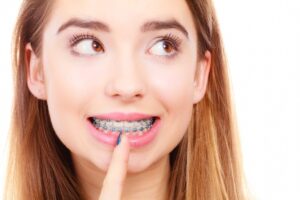 Caring for Braces During a Quarantine